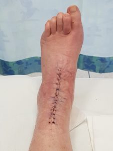14 Stitches!